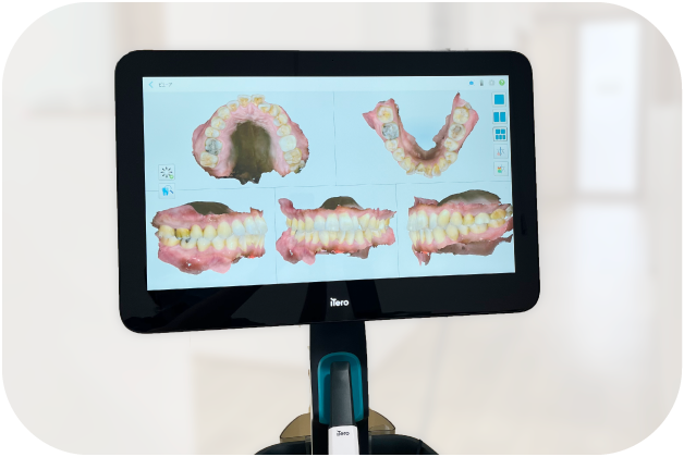 口腔内スキャナー（iTero Lumina）